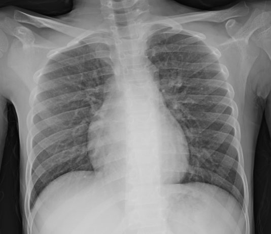 COVID-19: case 48 mini pediatric serial cases