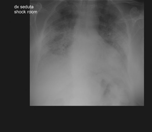 COVID-19: case 9 RX torace a letto