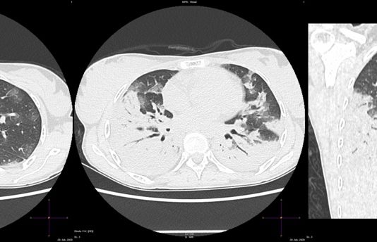 COVID-19: caso 6 covid19_caso6