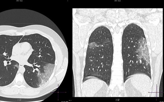 COVID-19: caso 7 covid19-caso7