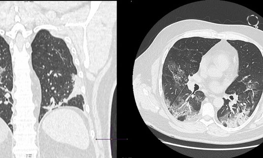 COVID-19: caso 5 covid19_caso5