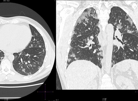 COVID-19: caso 4 covid-19_caso4