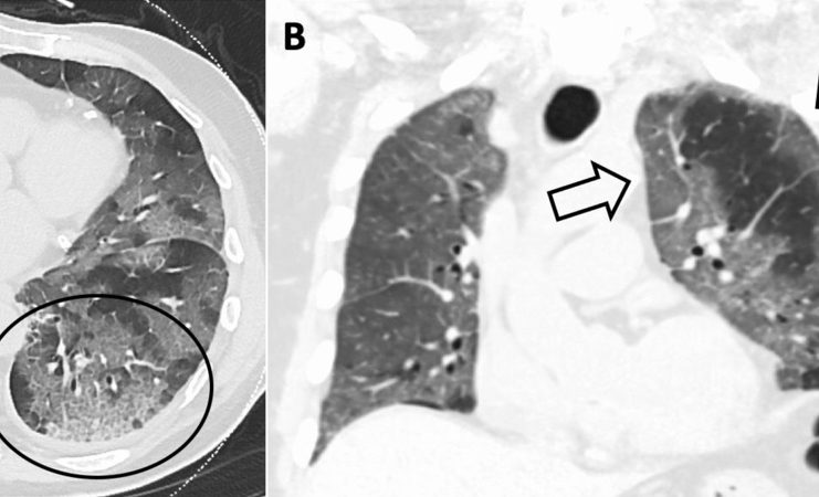 COVID-19 Corona visibile: casistica radiologica italiana