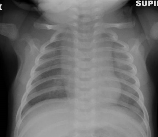 COVID-19: caso 92 – mini review pediatrica